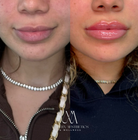 dermalfillers Result