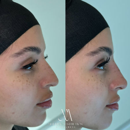 dermalfillers Result