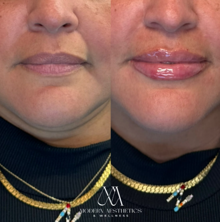 dermalfillers Result