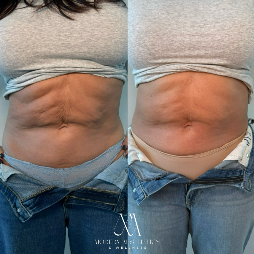 emsculpt Result