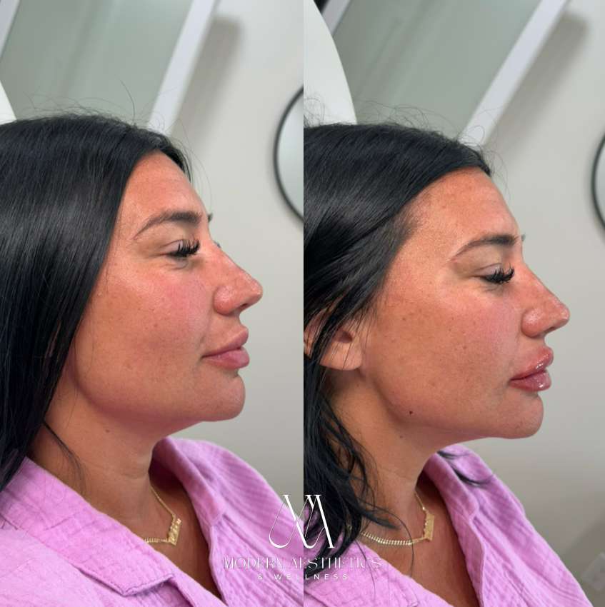 JawlineFiller Result