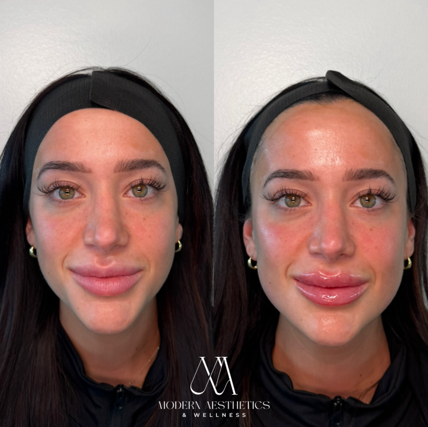 JawlineFiller Result