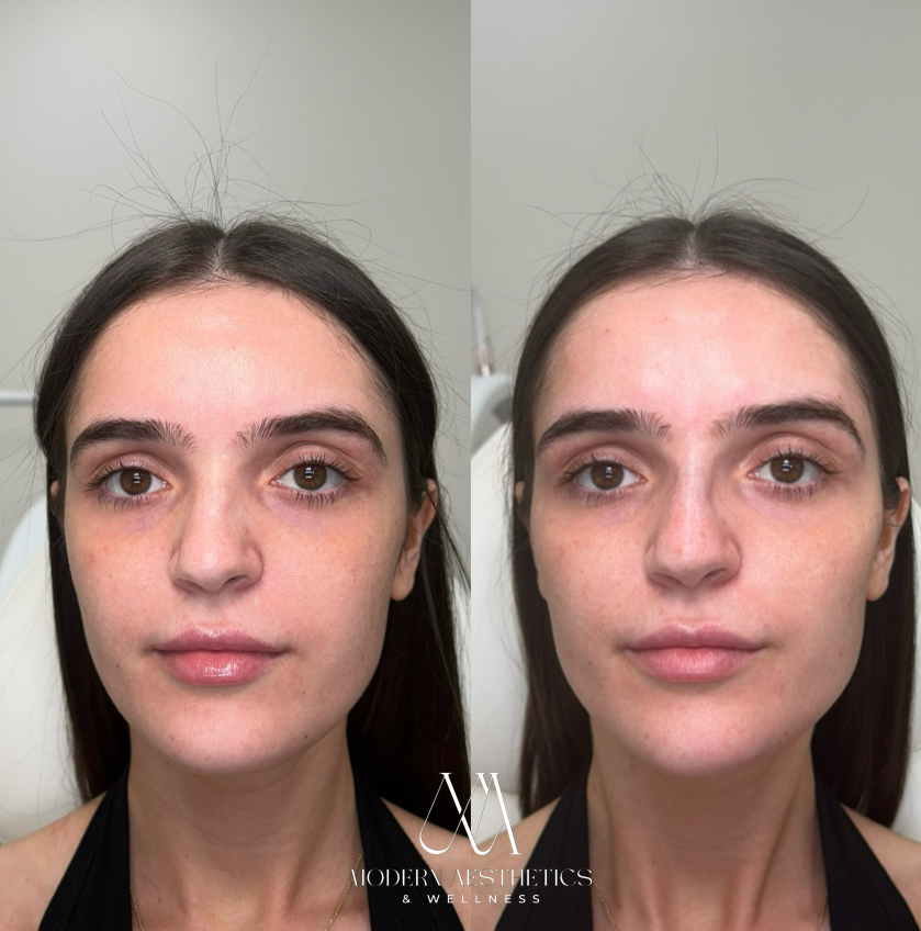 JawlineFiller Result
