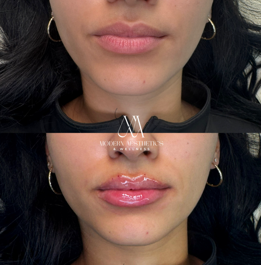 LipFiller Result
