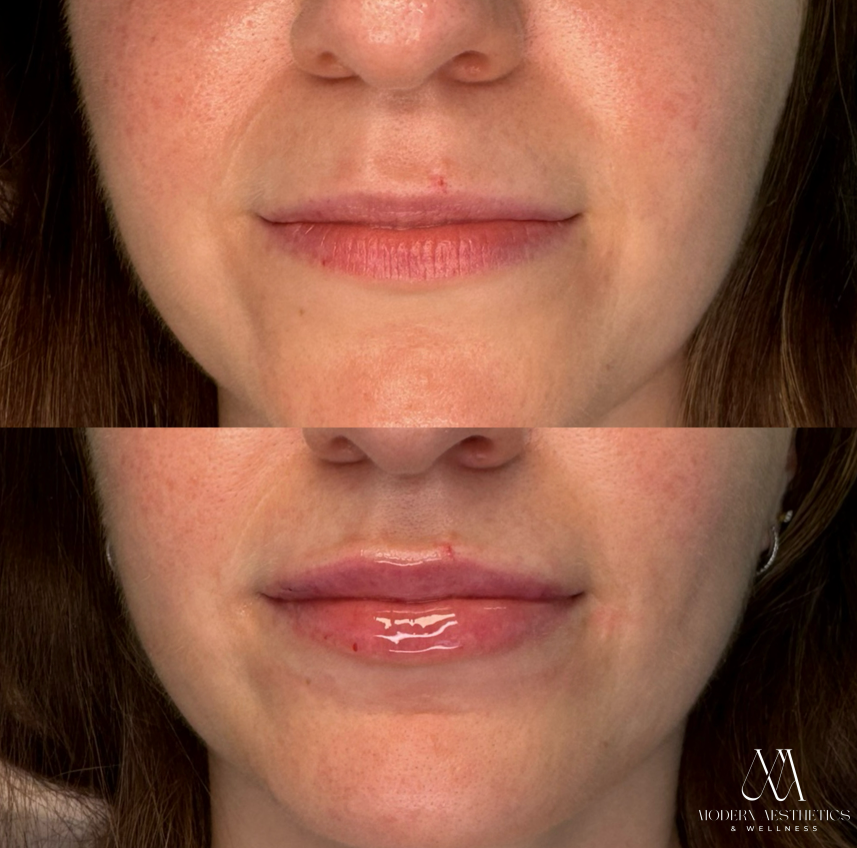 LipFiller Result