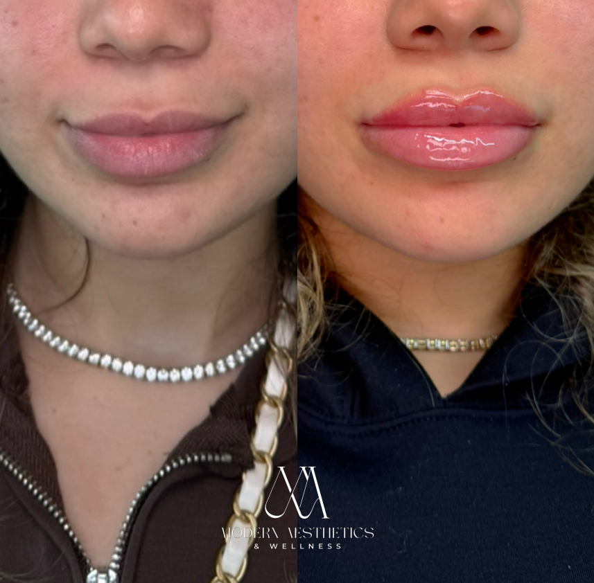 LipFiller Result