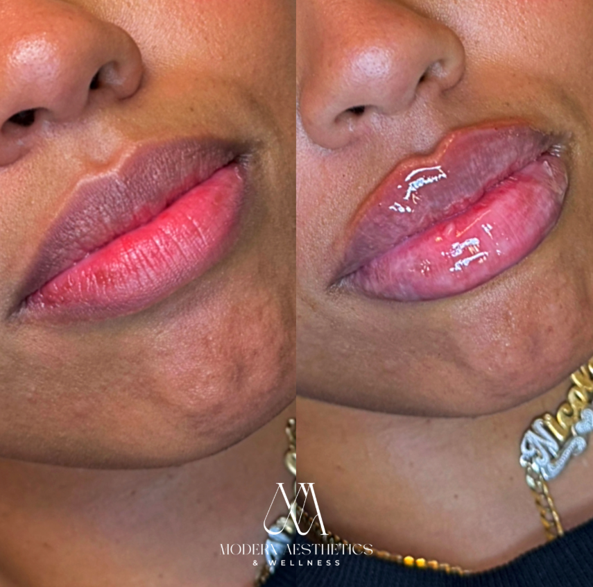 LipFiller Result