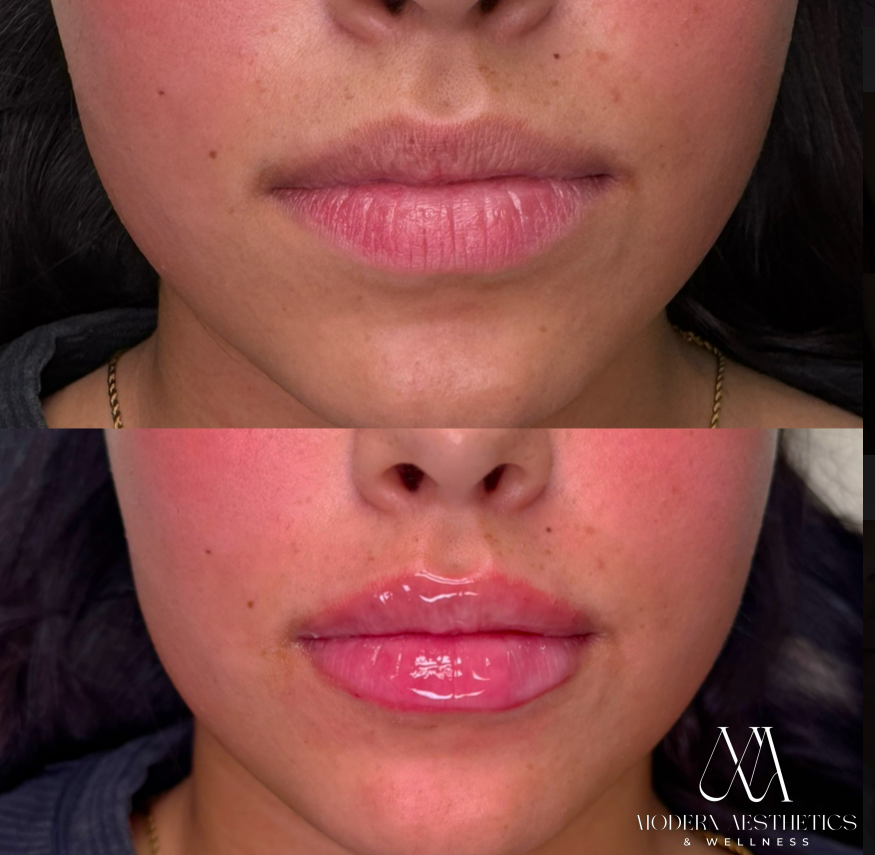 LipFiller Result