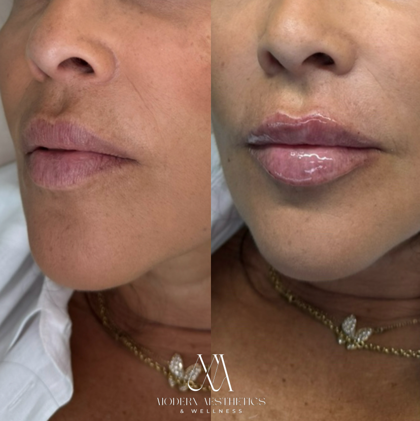 LipFiller Result