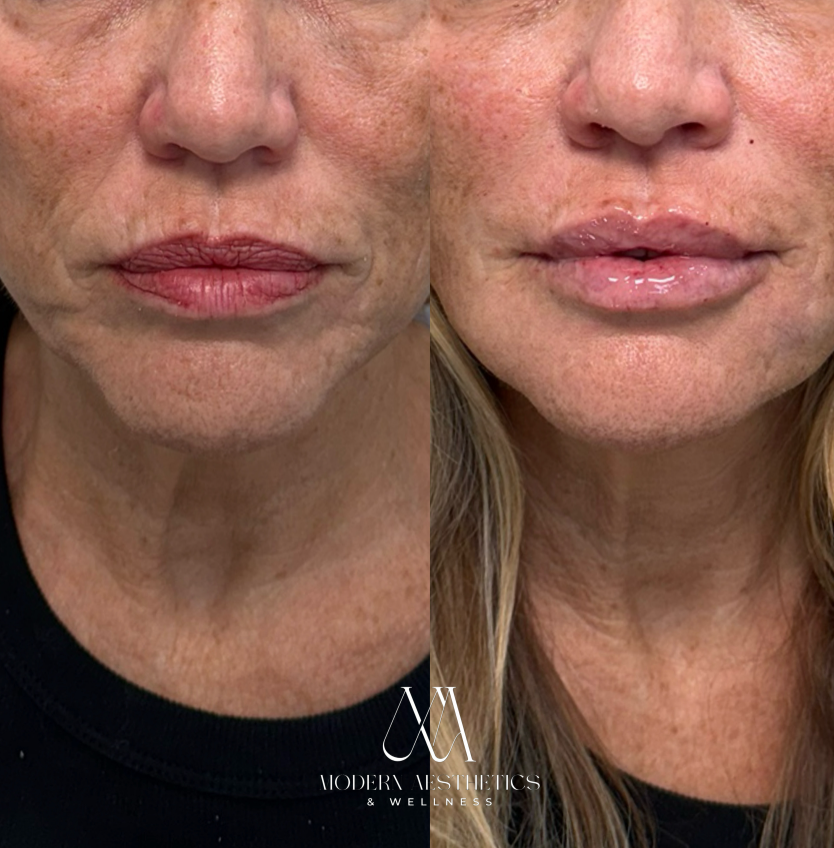 LipFiller Result