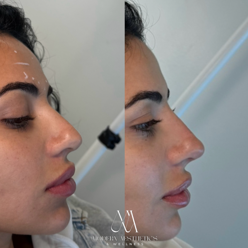 LiquidRhinoplasty Result