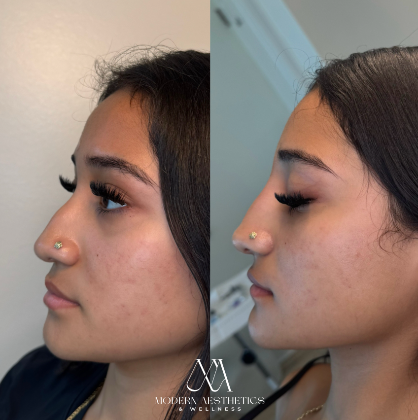 LiquidRhinoplasty Result