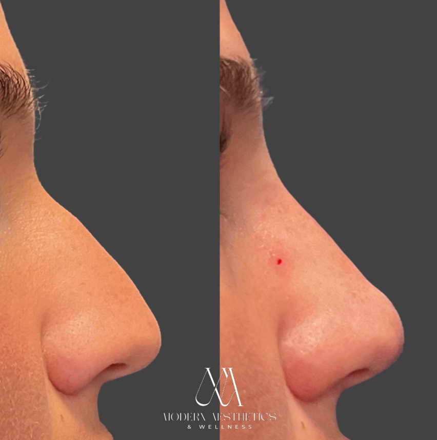 LiquidRhinoplasty Result