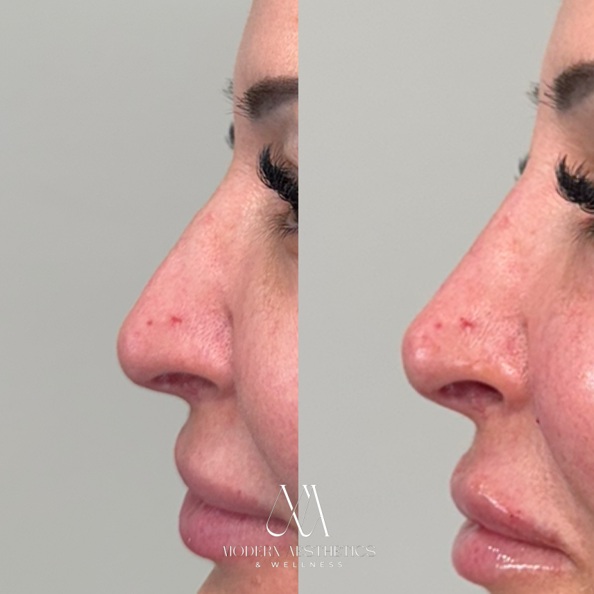 LiquidRhinoplasty Result