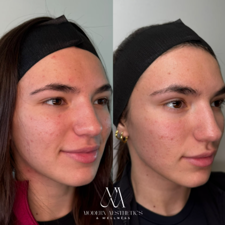 microneedling Result