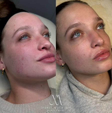microneedling Result