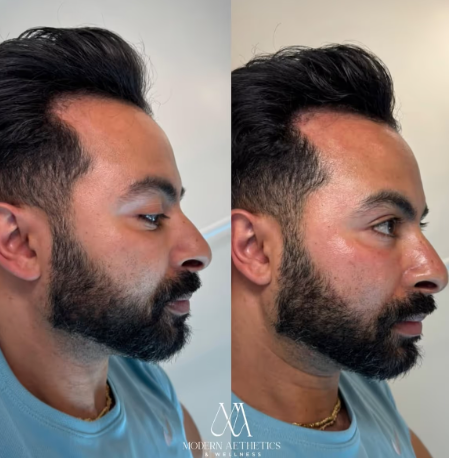 microneedling Result